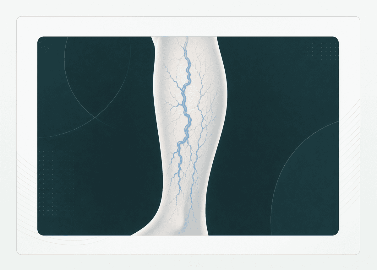 Schematic illustration of blue varicose veins in a lower leg